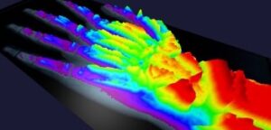 Digital analysis of radiograms in traumatology and orthopedics