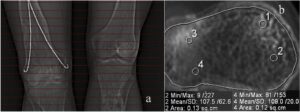 Detecting reasons for recurrent deformity in treatment of patients with vitamin D–resistant rickets using diagnostic imaging