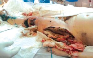 Classification of traumatic integumentary tissue degloving