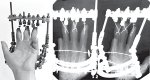 History of the Ilizarovs wire-fixator, stages of hand surgery development at the Ilizarov Center