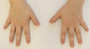 Application of external fixation apparatus for surgical treatment of congenital brachymetacarpia of the 5th ray of the hand, brachydactyly of the 1st and 5th rays of the hand