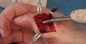 Method of using an external fixation device for surgical treatment of pseudoarthrosis in combination with deformation of the first finger.