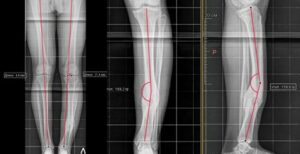 Correction of post-traumatic deformation of the leg bones using the Ilizarov apparatus.