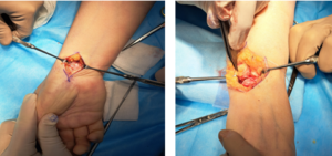 Modification of proximal row carpectomy (PRC) technique for adaptive wrist collapse
